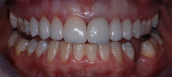 After Veneer RP