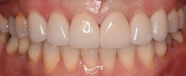 After Veneer YW