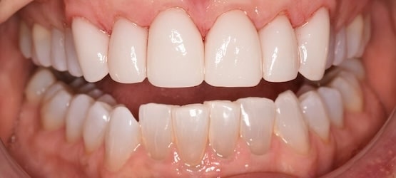 After Veneers CG