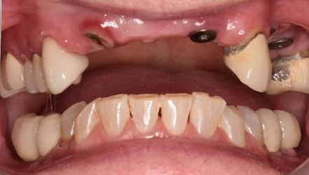 Before Restoration LS
