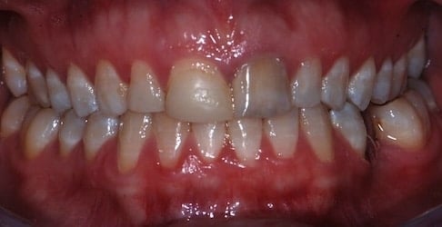 Before Veneer RP