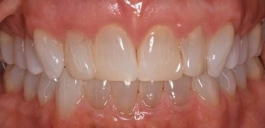Before Veneers CG