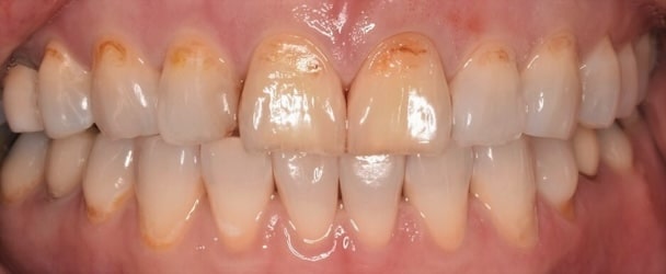 Before veneer YW